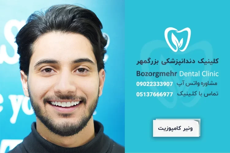 کامپوزیت دندان در مشهد | بهترین کلینیک + قیمت 1401