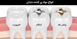 پر کردن دندان مشهد