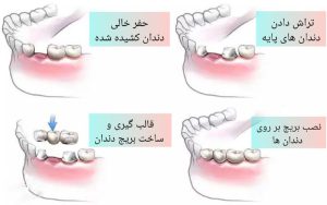 بریج دندان در مشهد