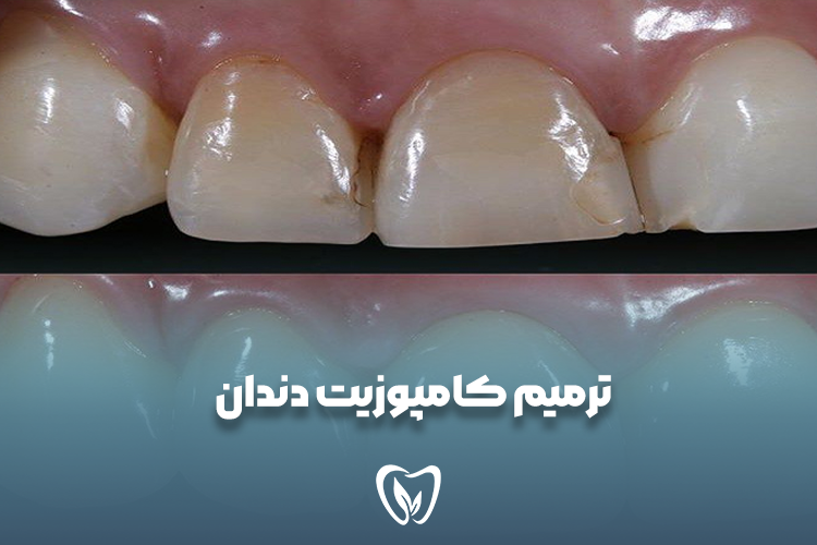 ترمیم کامپوزیت دندان