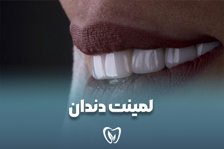 لمینت دندان مشهد