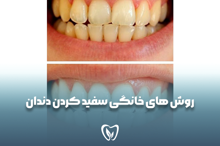 روش های خانگی سفید کردن دندان