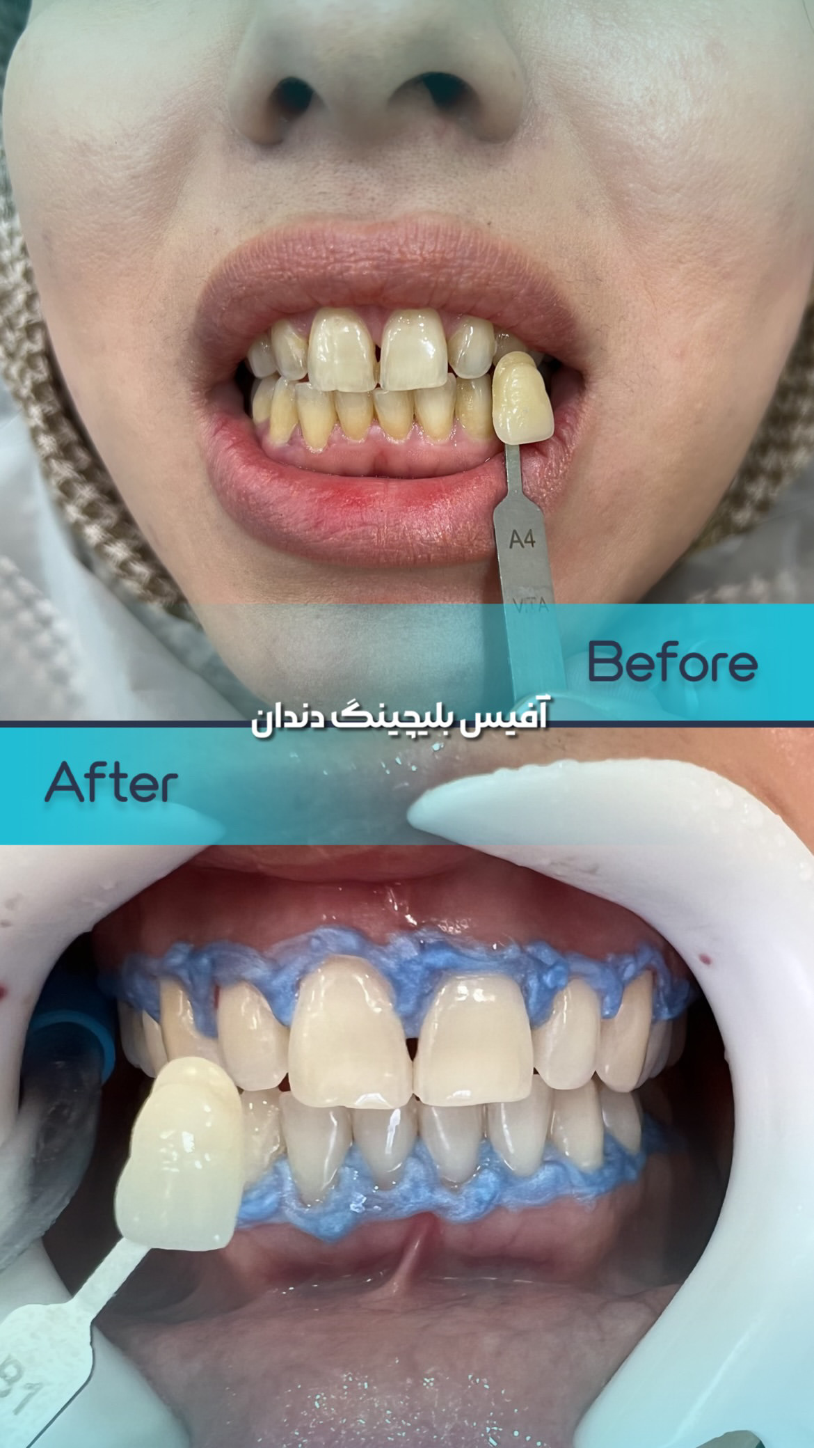بلیچینگ دندان مشهد