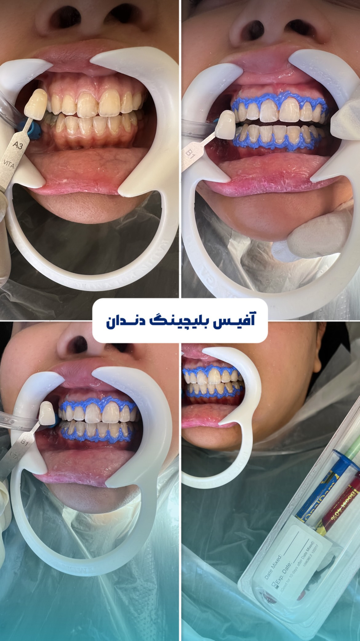 بلیچینگ دندان مشهد
