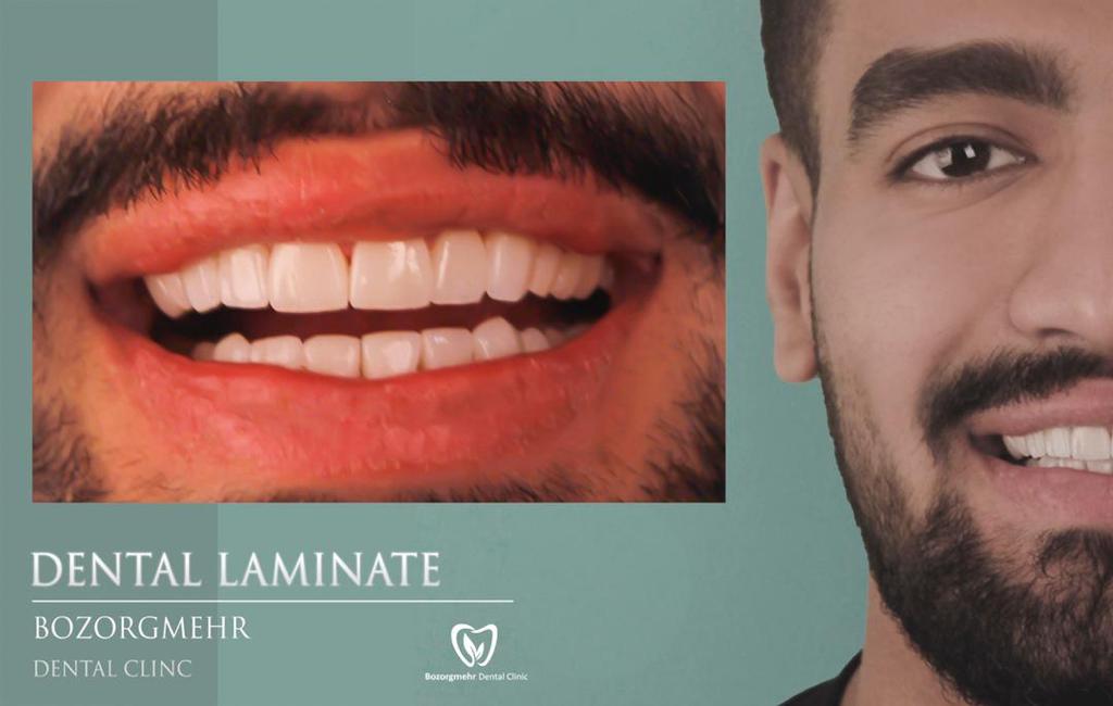 لمینت دندان مشهد