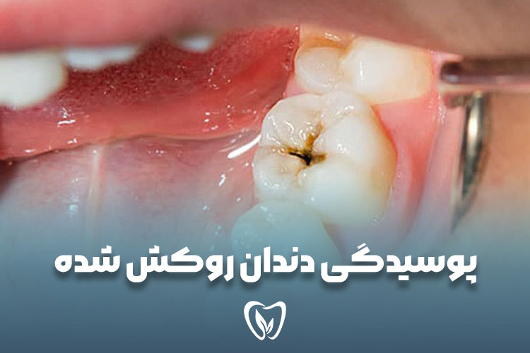پوسیدگی دندان روکش شده