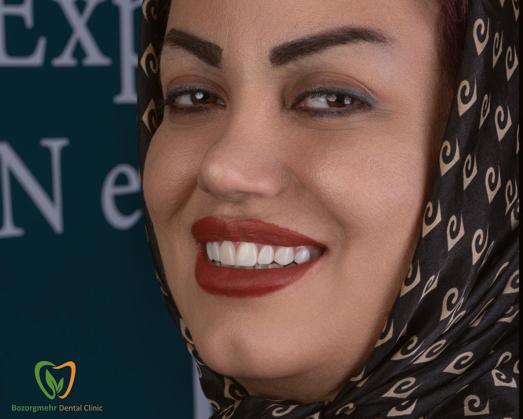کامپوزیت دندان مشهد