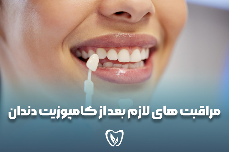 مراقبت های بعد از کامپوزیت دندان